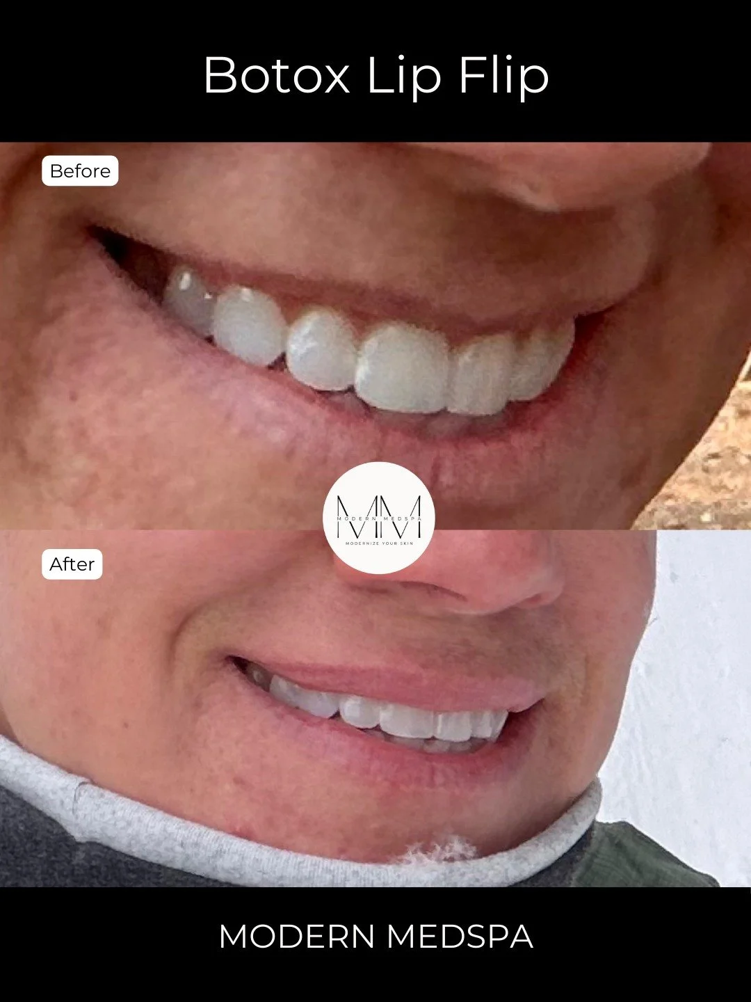 This patient wanted a subtle enhancement without filler. A lip flip helped relax the upper lip just enough to soften her smile. She loved it so much she sent us her own after photo 🤍