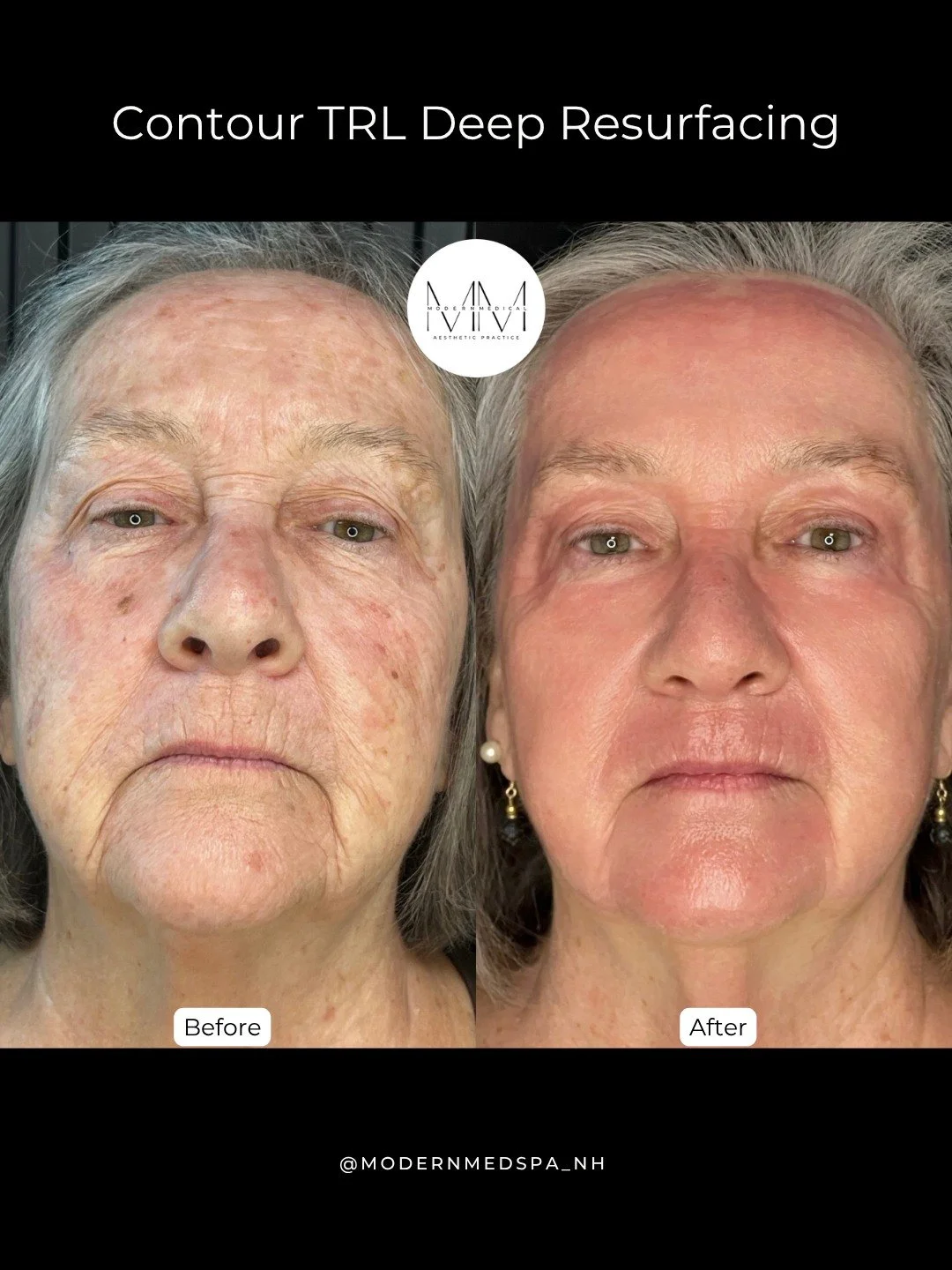 This is what deep resurfacing can do✨ With Contour TRL, we&rsquo;re not just treating one concern, we&rsquo;re improving overall skin quality! This patient's skin texture is smoother, tone is more even, pigmentation is reduced, and the skin appears t