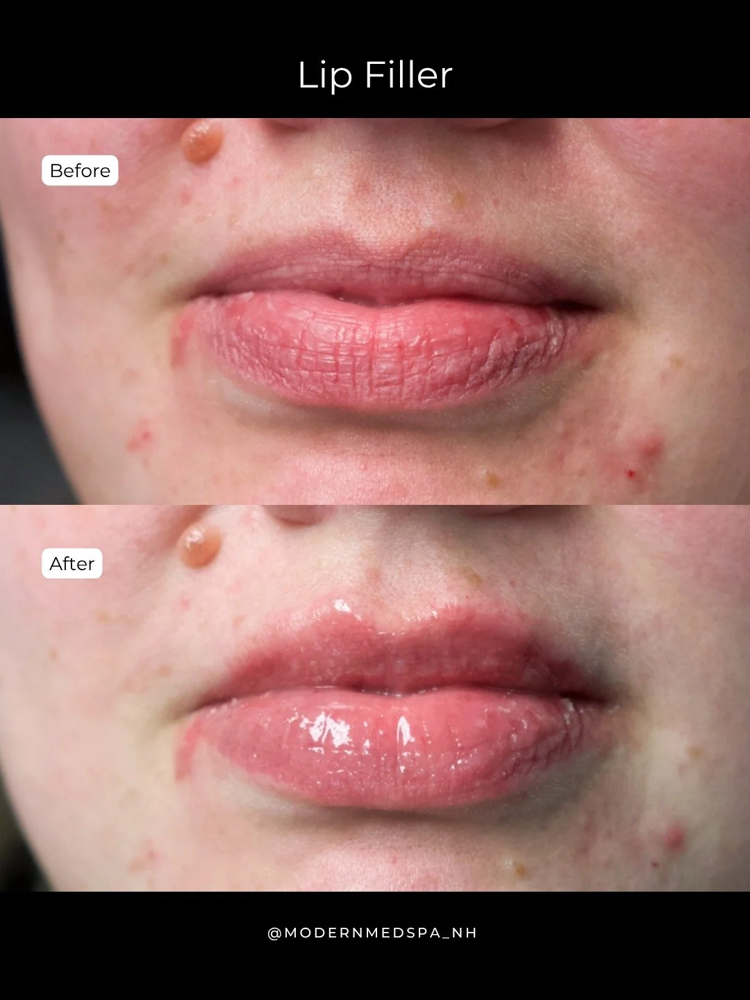 A little balance goes a long way 🥰 Volume was added to the upper lip to match the lower lip, while enhancing hydration and smoothing the overall lip texture!