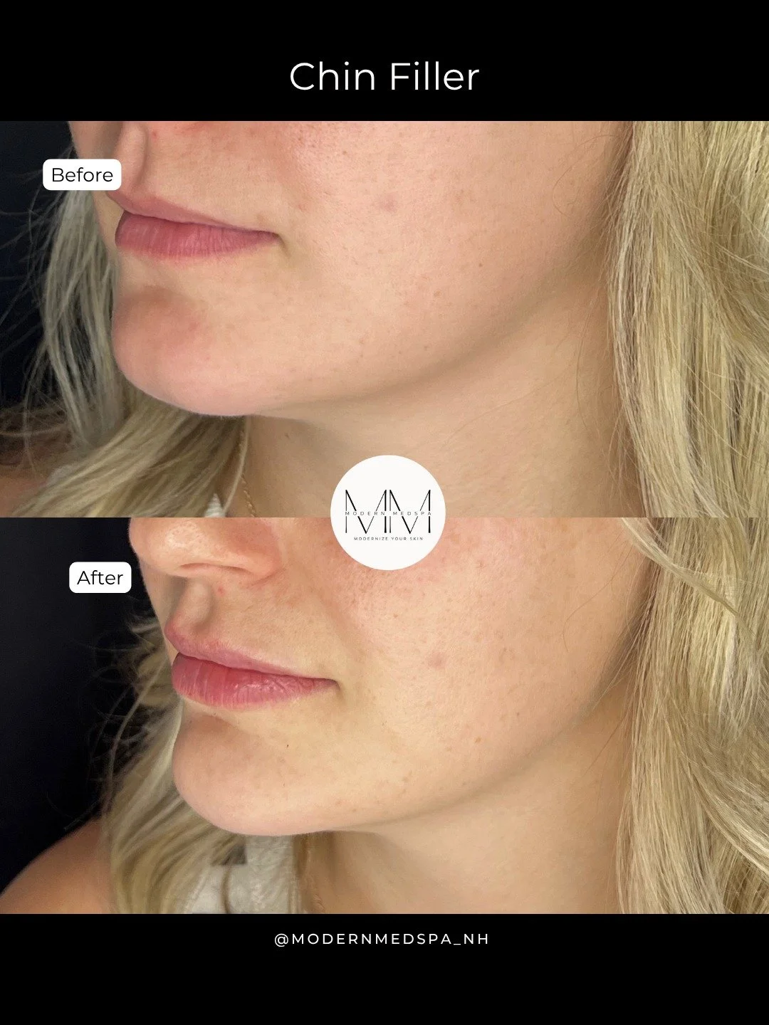 Chin filler can subtly define the jawline, balance your profile, and bring harmony to your features without looking overdone. Sometimes it&rsquo;s the smallest tweaks that make the biggest difference ✨