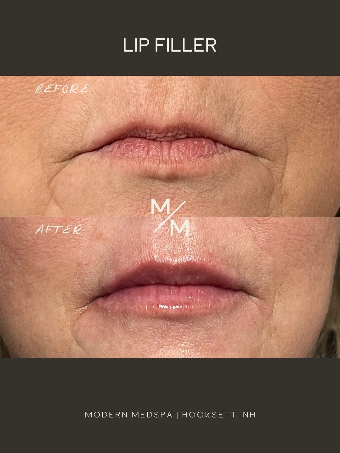 A soft, natural refresh to restore volume and hydration, creating a smoother, more polished look that still feels completely like her ✨
