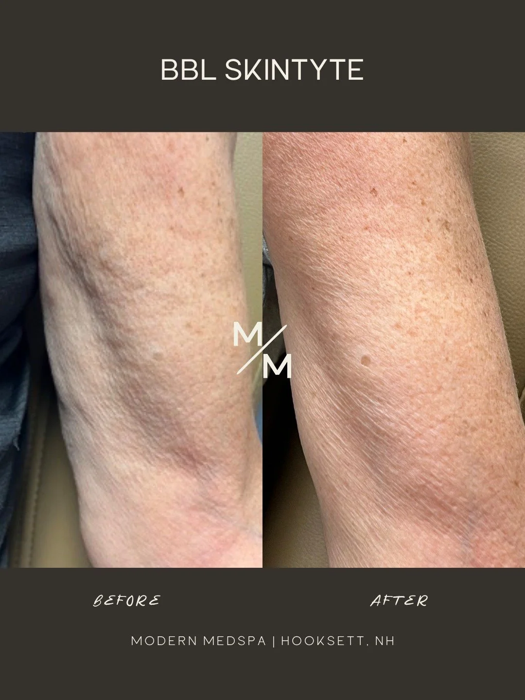 This patient wanted to address mild skin laxity and support overall firmness. BBL SkinTyte works by stimulating collagen remodeling to gradually improve tightness and skin support over time ✨
