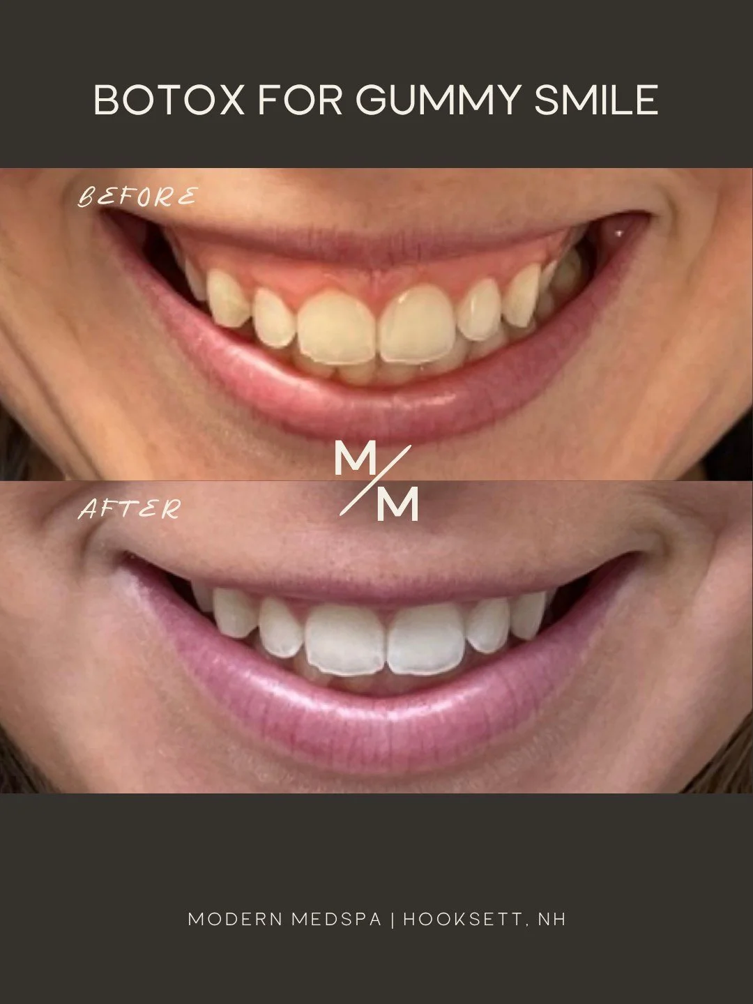 A subtle treatment with beautiful results 💉 Botox can help relax the upper lip to reduce the appearance of a gummy smile, creating a more balanced, confident look while still keeping your smile natural. Quick treatment, minimal downtime, and results