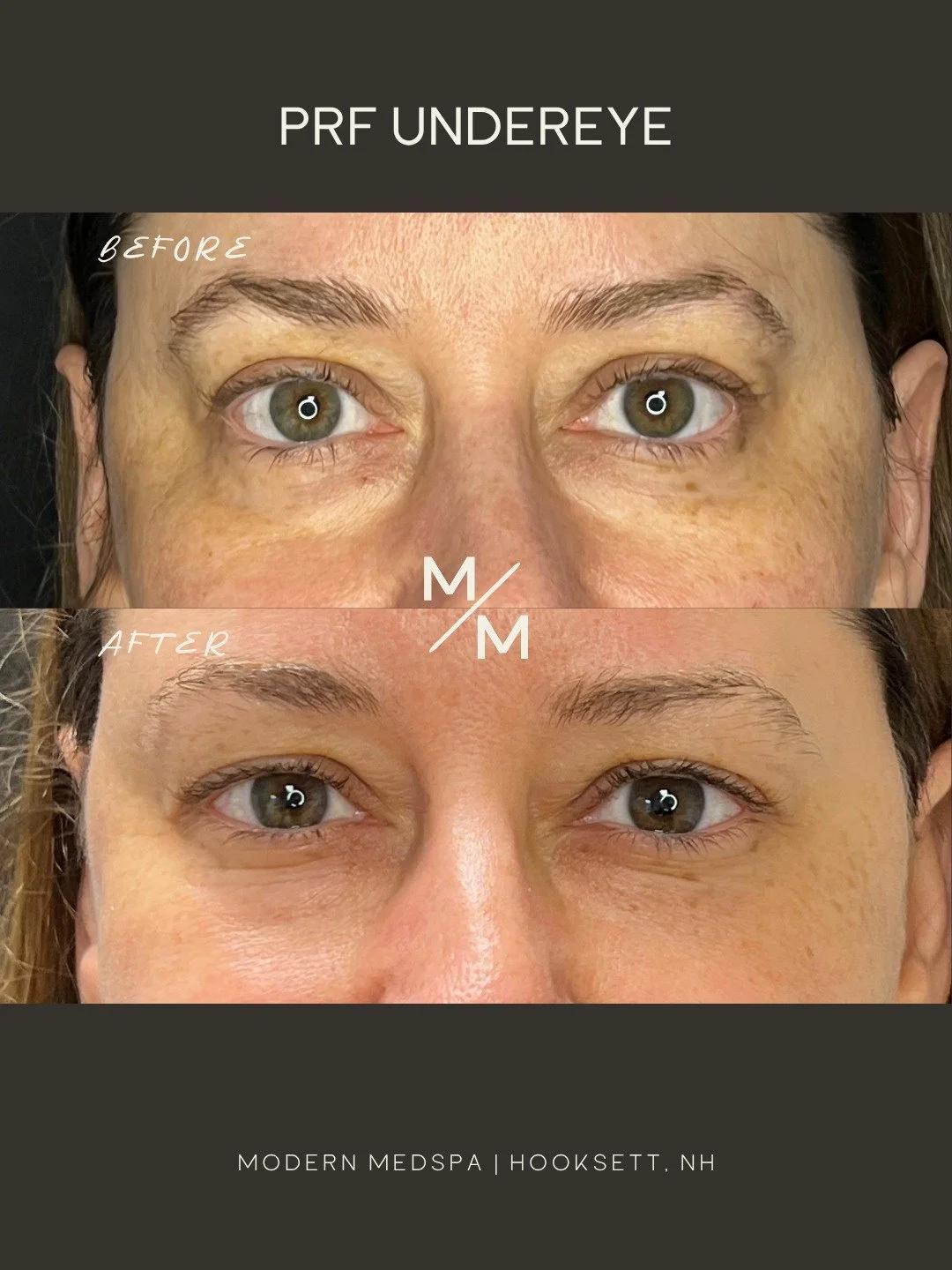 Refresh tired eyes naturally with PRF (Platelet-Rich Fibrin) 💉 Using your body&rsquo;s own growth factors, PRF helps improve under-eye hollowness, fine lines, dark circles, and overall skin quality by stimulating collagen and rejuvenation from withi