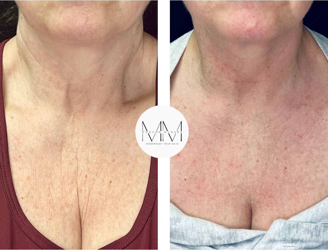 VYBE microneedling with radiofrequency before and after on chest