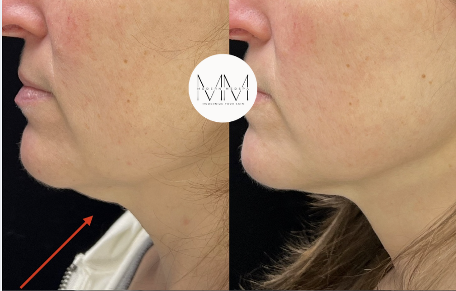 VYBE microneedling with radiofrequency on the neck before and after