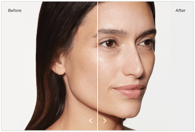 Sculptra-Before-After-Gabriela.png