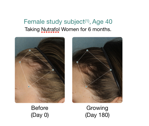 Hair restoration