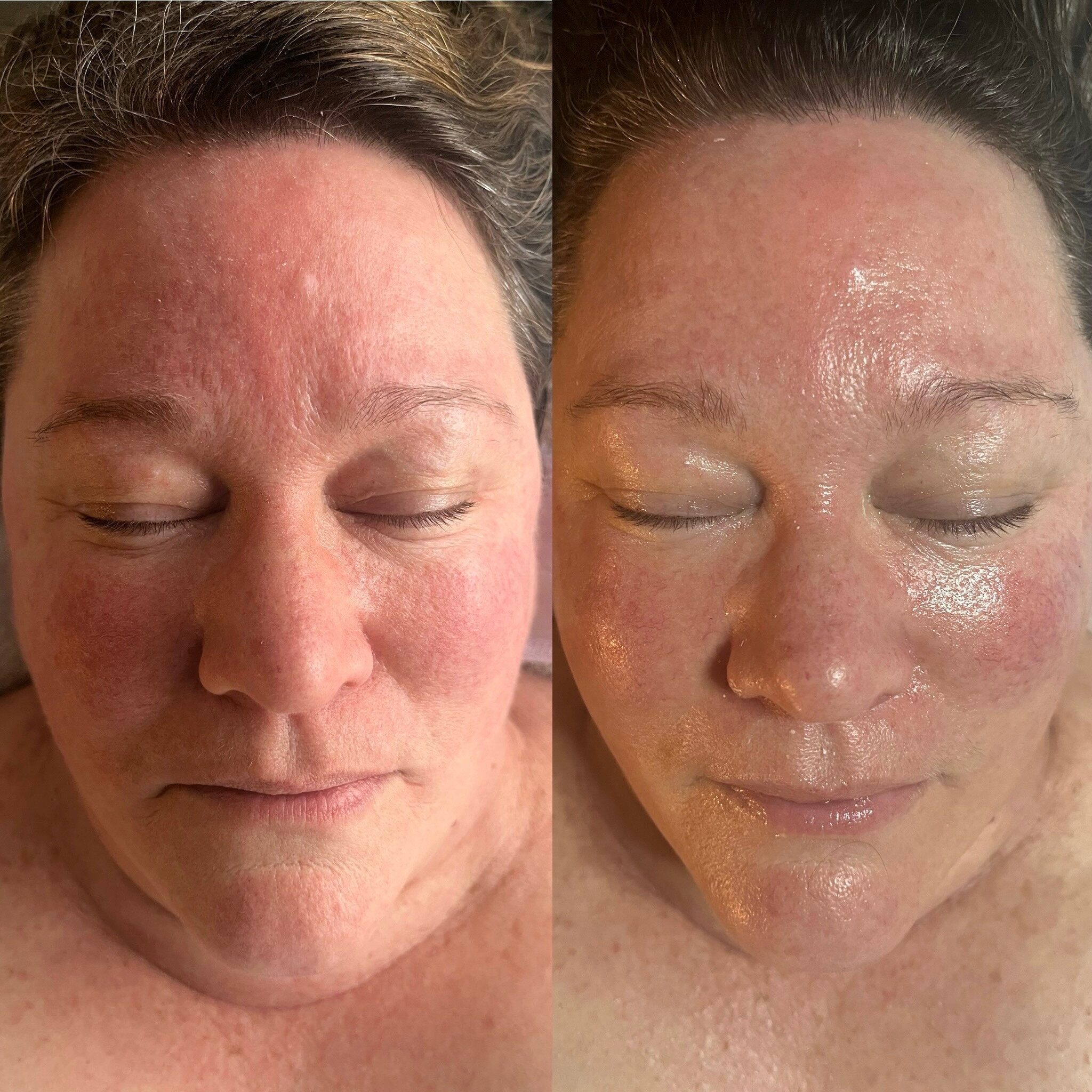 Look at these cheek bones come to life! First time client and we did Oxygen Therapy + LED  Light + Gua Sha. Our focus was to lessen the redness, sculpt and revitalize the skin. Consistency is always the key ingredient to happy and healthy skin. No fi