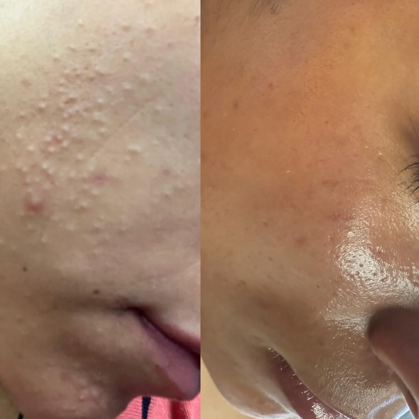Skin Transformation Time!! Loving how far her skin has come. This takes consistency and patience!  It can be achieved.  Amazing to see how much life has returned to her skin. We are nourishing it the Mandelic Nightly Calibrator by @navinka_skincare f