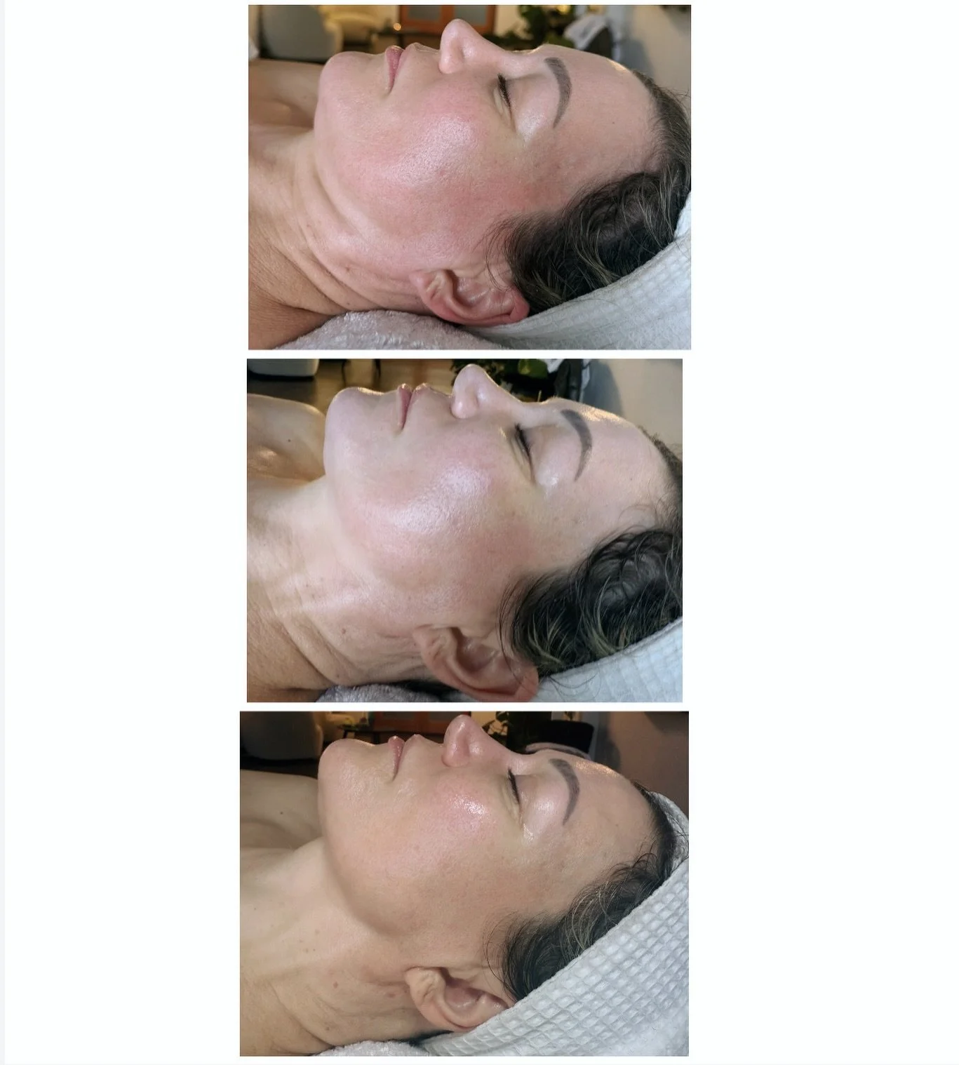 This MICROCURRENT transformation deserves its own post! The targeted goal was to focus on lifting and redefining the jawline. The top photo is before, middle is after one session and bottom photo is after seven. Treatments were about 5-7 days apart f