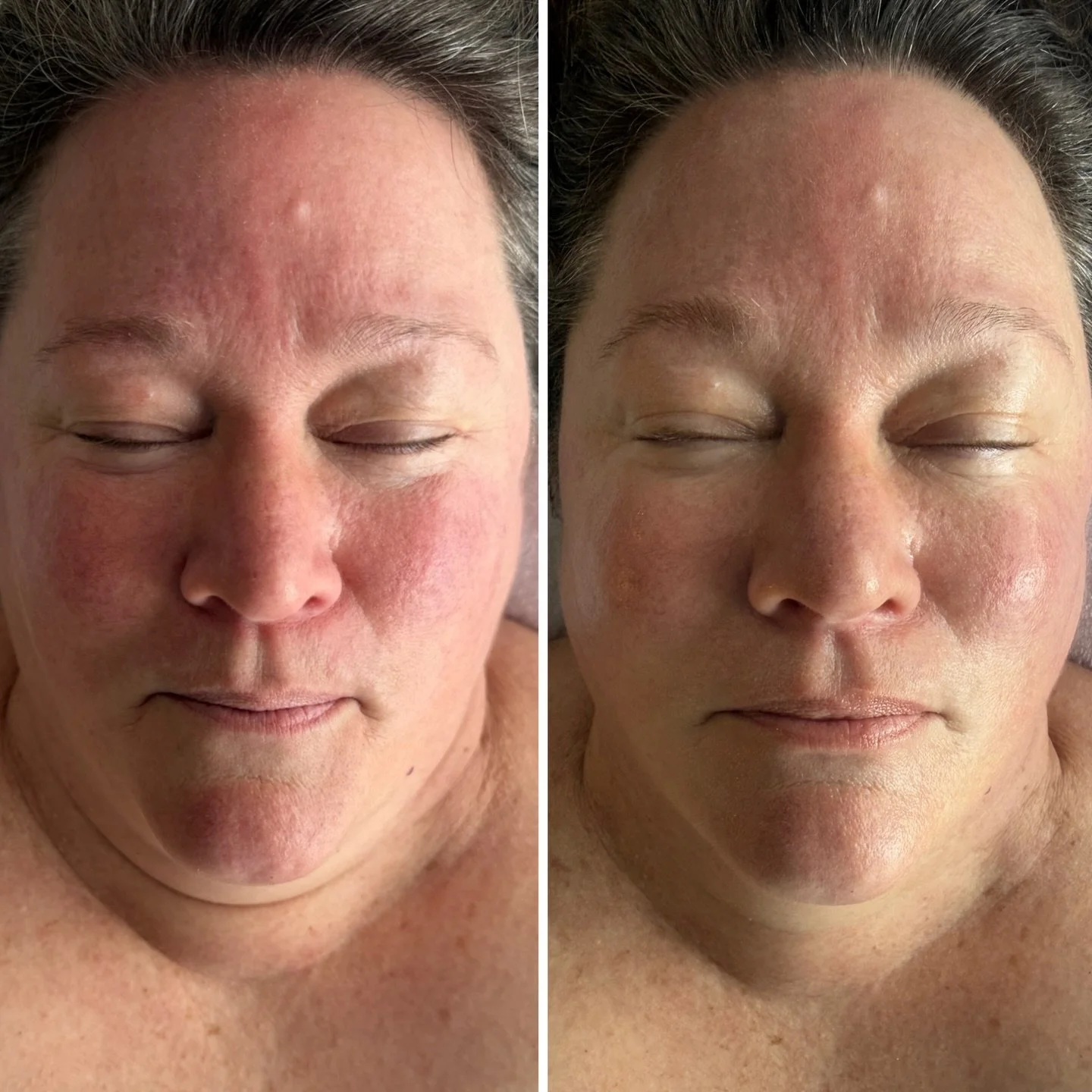It&rsquo;s been awhile since I&rsquo;ve posted! Time flies. In complete awe of this before and after. I&rsquo;m always sharing with guests of the studio that our skin and facial muscles can easily be transformed with gentle approaches. This treatment