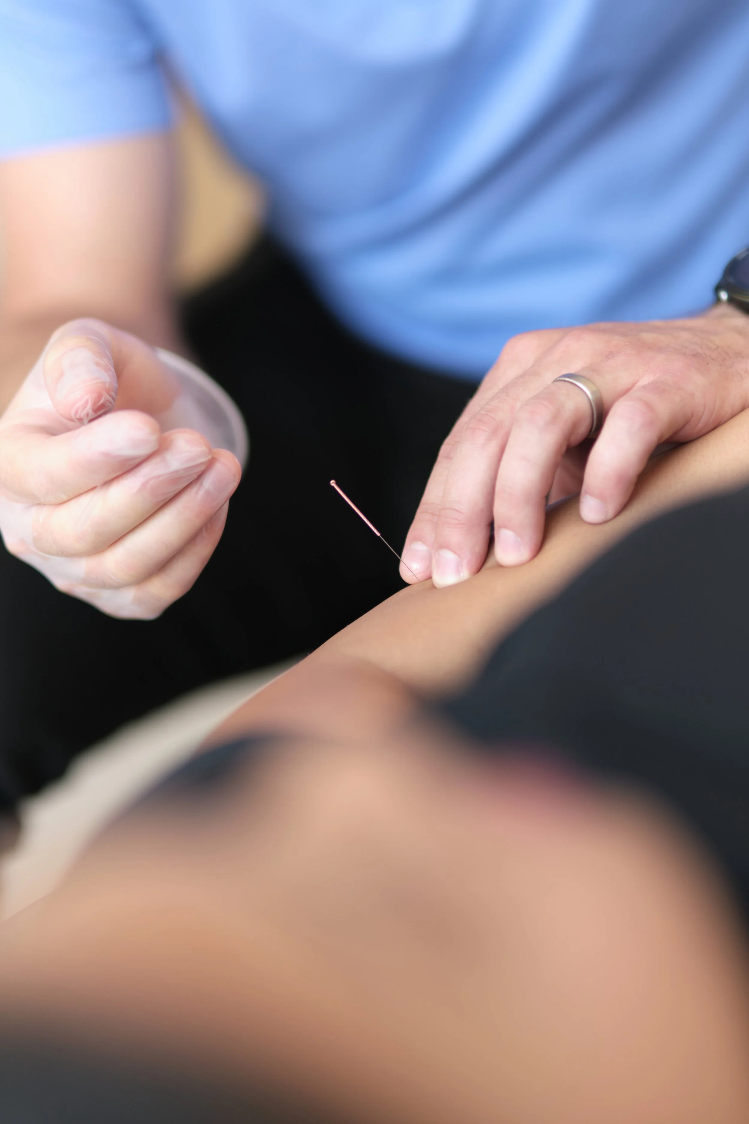 Davin Mackenzie Physiotherapist using IMS/Dry needling At Aeris Physiotherapy in Port Moody