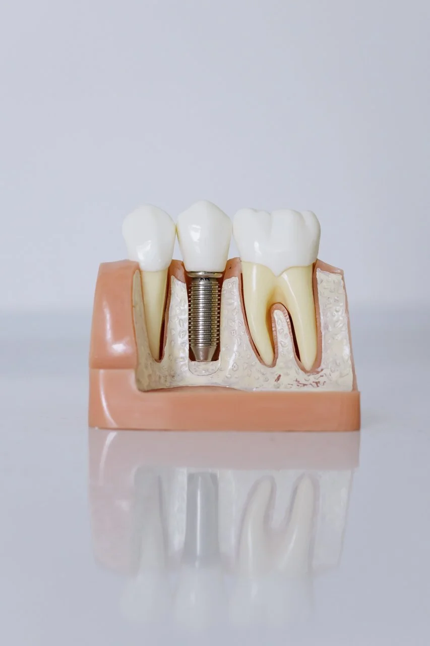 example of dental implant