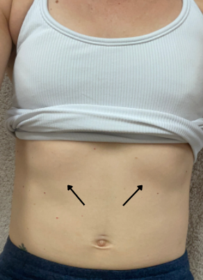 What is a rib flare and how to correct it? — Erica Friedman Wellness