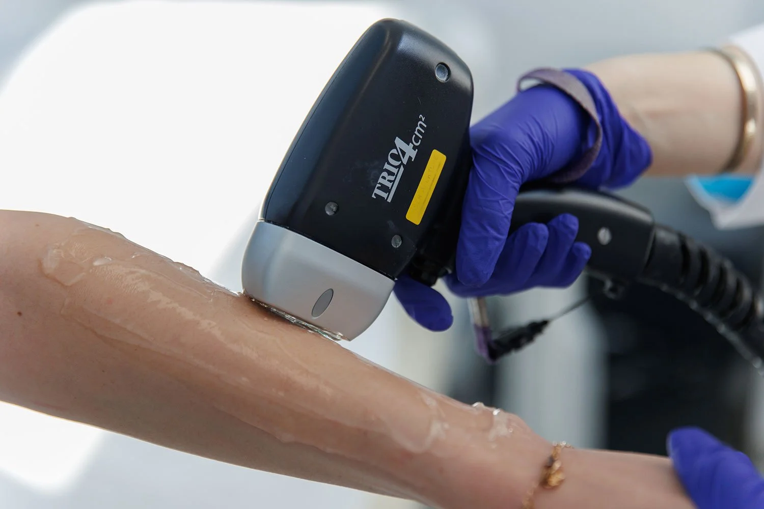 ¿Qué esperar después de una sesión de depilación láser? Guía de post-tratamiento