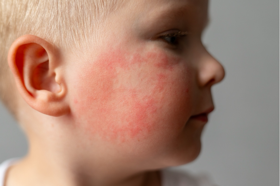 Dermatitis Atópica en Adolescentes: Cómo Cuidar la Piel durante la Adolescencia