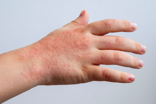 Dermatitis de Contacto: causas, síntomas y tratamiento con dermatólogo en Panamá