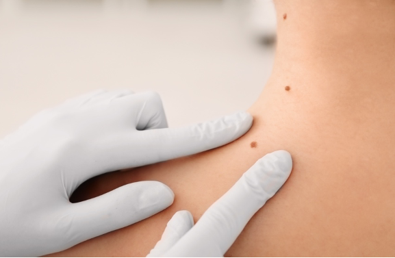 Lunares en Panamá: cuándo un dermatólogo debe evaluarlos