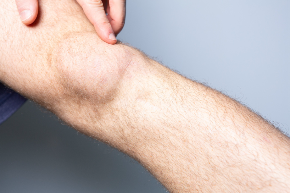 Remoción de lipoma: cuándo es necesaria y por qué acudir al dermatólogo