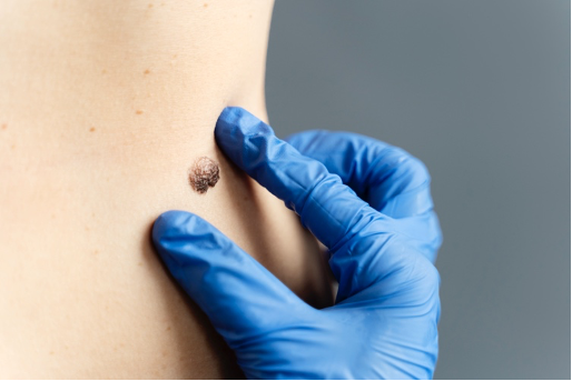 Lunares en la piel: cuándo preocuparse y cuándo retirarlos