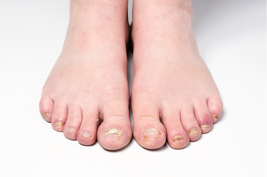 Micosis: cómo identificar y tratar las infecciones por hongos