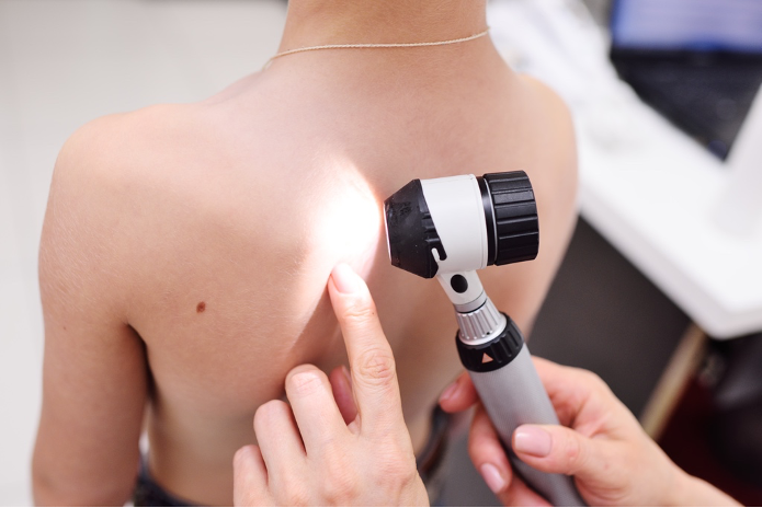 Dermatoscopía: evaluación avanzada de lunares y lesiones cutáneas con dermatólogo en Panamá