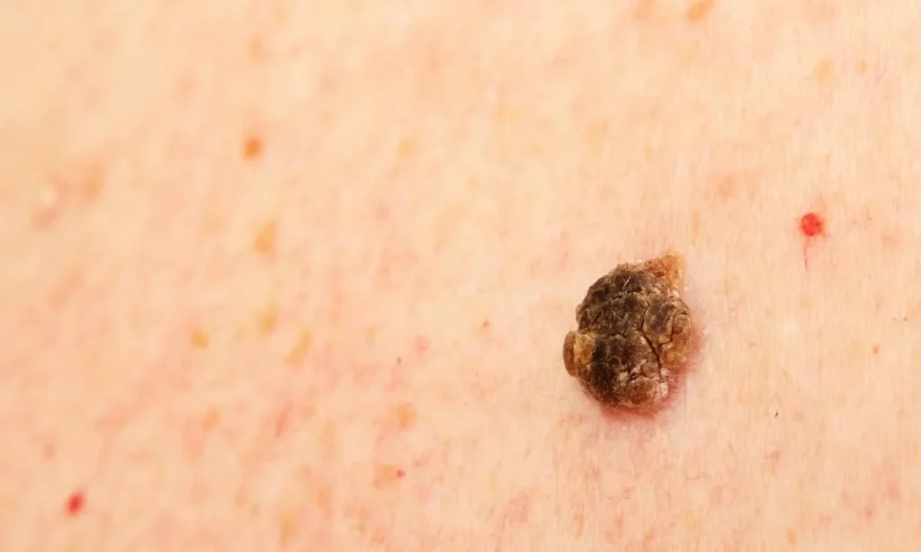 Eliminación de queratosis seborreicas: procedimiento efectivo y confiable