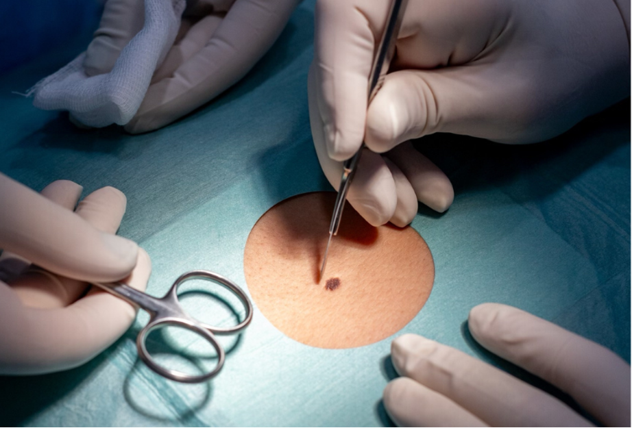 Cirugía de cáncer de piel: tratamiento oportuno y seguro