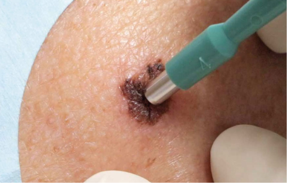 Biopsias de piel: qué son, tipos y por qué son importantes