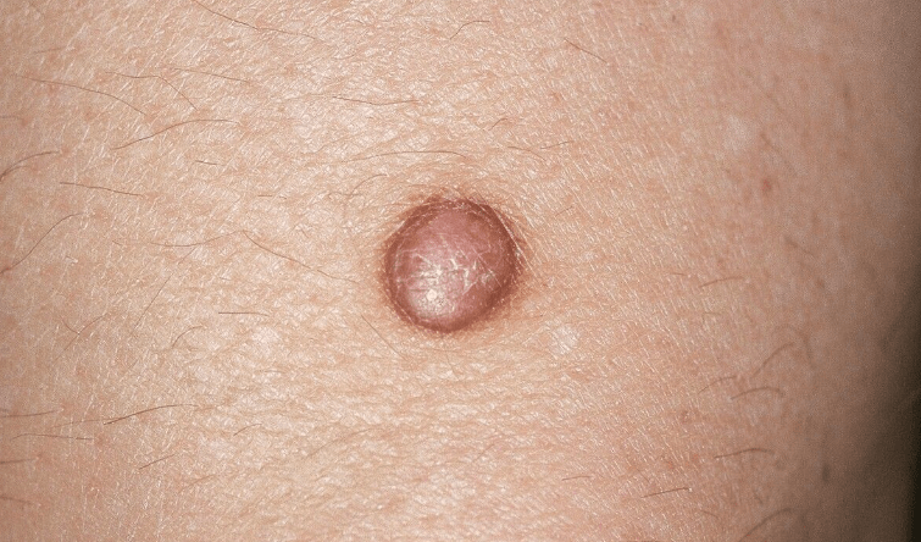 Lesiones cutáneas comunes: cómo identificar un dermatofibroma