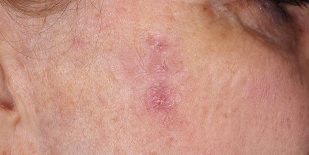 Tratamiento de Queratosis Actínica en Panamá: protege tu piel del daño solar