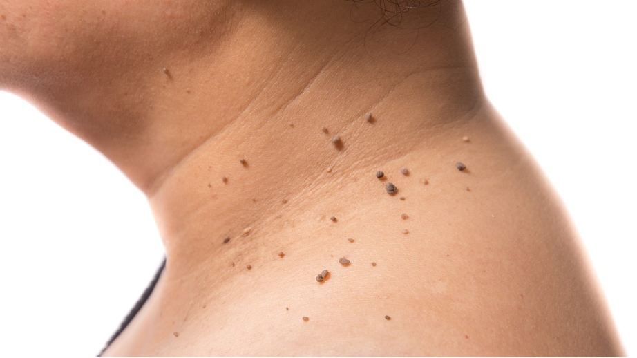 Acrocórdones: qué son, por qué aparecen y cómo se eliminan de forma segura