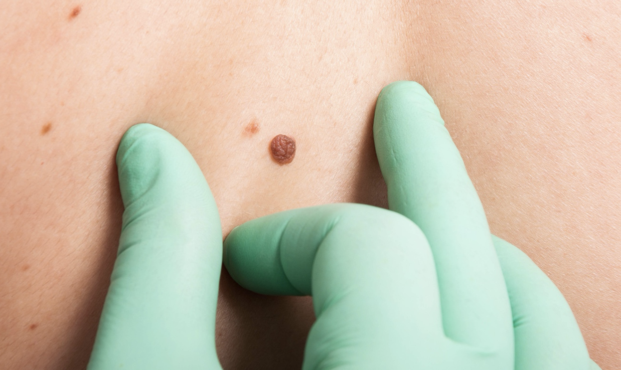 Cirugía de lesiones benignas: seguridad y resultados estéticos