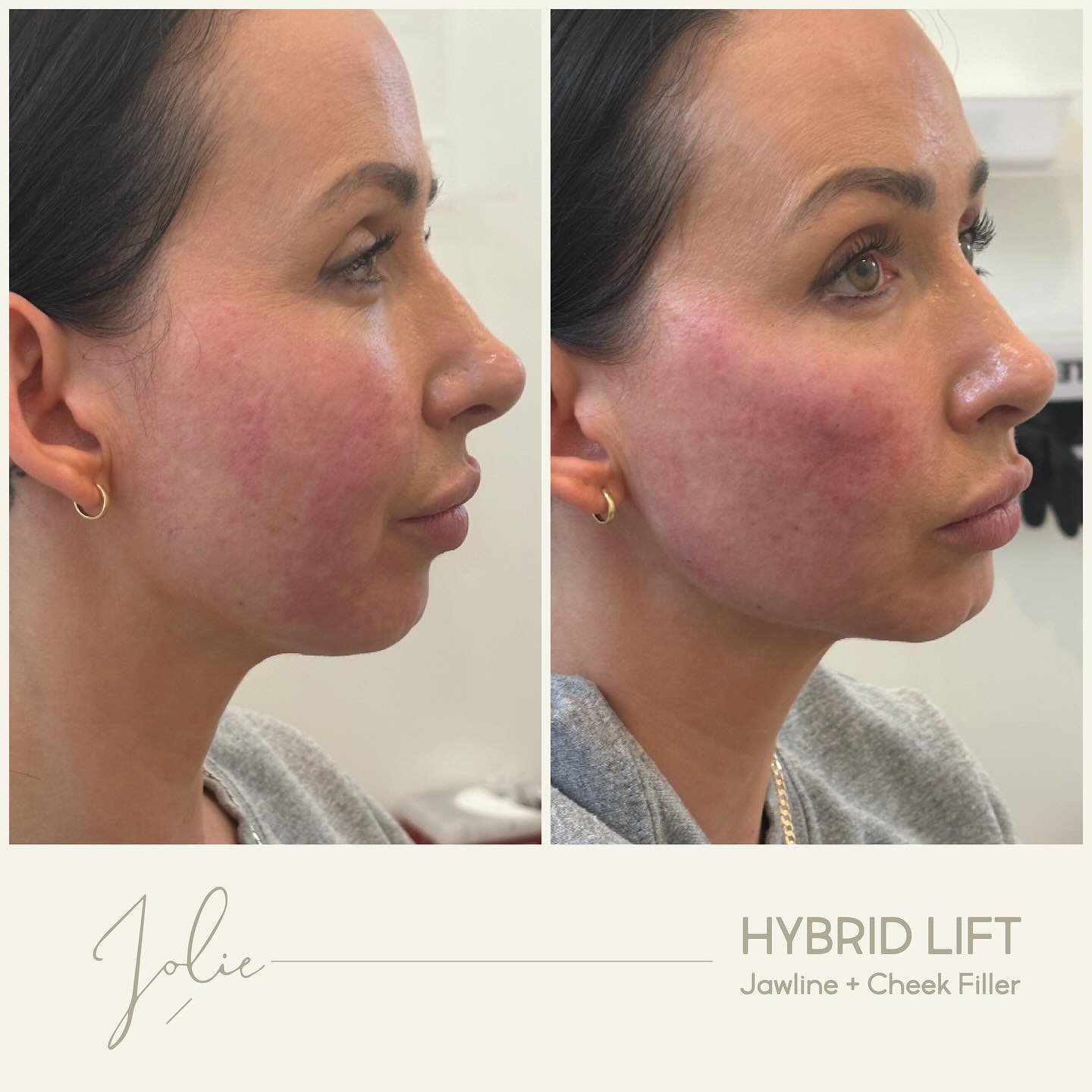 ✨HYBRID LIFT✨
Discover our innovative filler fusion method, blending two distinct fillers for an exceptional, uplifting transformation. Experience the ultimate support for your beauty journey.

Can be used in:

🧡 Temples
🩵 Midface
💛 Jawline
🩷 Nas