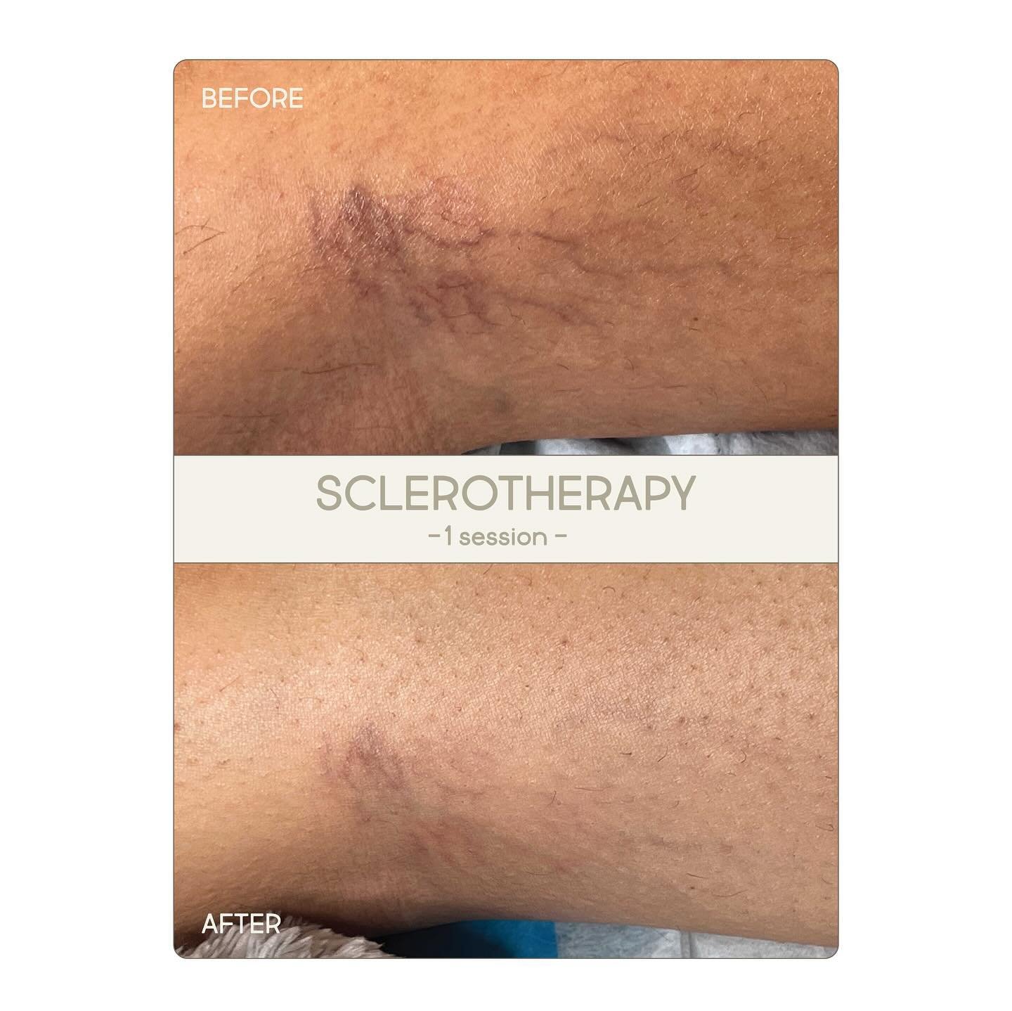 Mother&rsquo;s Day Flash Sale
⭐️SCLEROTHERAPY⭐️

Promo:
- Buy one get one free session
- Call and prepay
- Valid thru 5/10-5/12

How to kiss stubborn veins goodbye 💋
A non-surgical, minimally invasive treatment removing varicose and spider veins usi