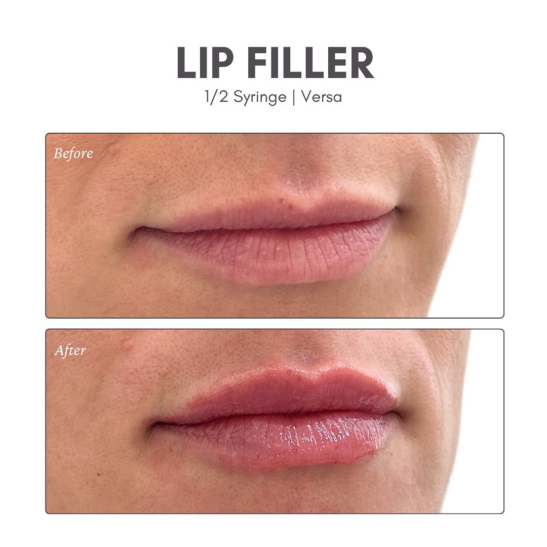 ✨ Monday Plump by @ali.injector 💉💕
These lips are giving soft, juicy, just-right.
Half syringe of Versa for this perfect pout.
💋 Book now&mdash;call or reserve online!
