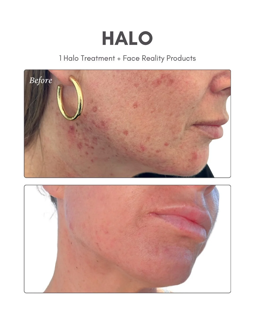 โญ๏ธ๐งHALO x Face Reality Progress๐งโญ๏ธ
Healing skin is like nurturing a garden - it takes patience, consistency, and the right tools. ๐ฟ
In May, this client began their Face Reality routine, feeding the skin what it needed to calm, clear, and reset it