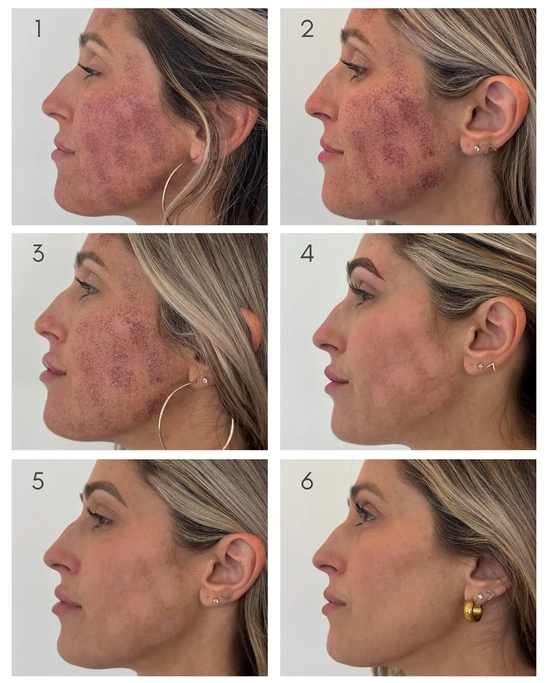 That post-laser era &gt;&gt;&gt; the dull skin era 

Two months after Halo and the glow is officially permanent 

⭐️The first week? A little downtime.
⭐️The next few? Collagen boost city.
⭐️Now? Brighter, smoother, tighter skin that just keeps gettin