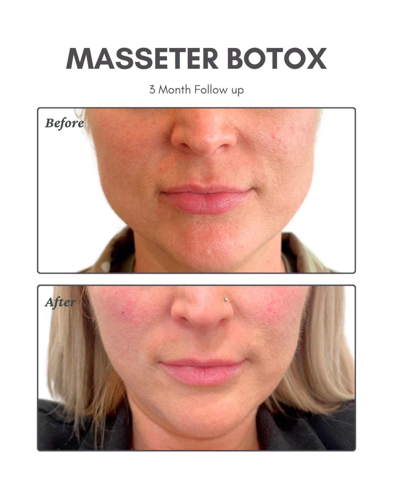 A little masseter magic ✨🪄
Three months after masseter Botox and the difference tells the story&mdash;less clenching, softer angles, smoother balance. A small treatment with big impact on comfort and contour.❄️⭐️

#masseterbotox #medspa #eastdalevil