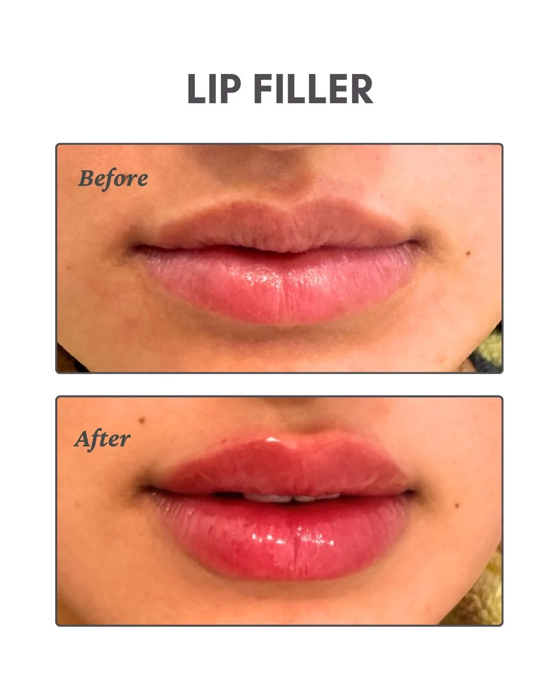 POV: your lips just got a little upgrade 💉✨
Before &amp; after that hits different.💋💕

#lipfiller #filler #hudsonvalley #medspa #jolieaestheticsandwellness