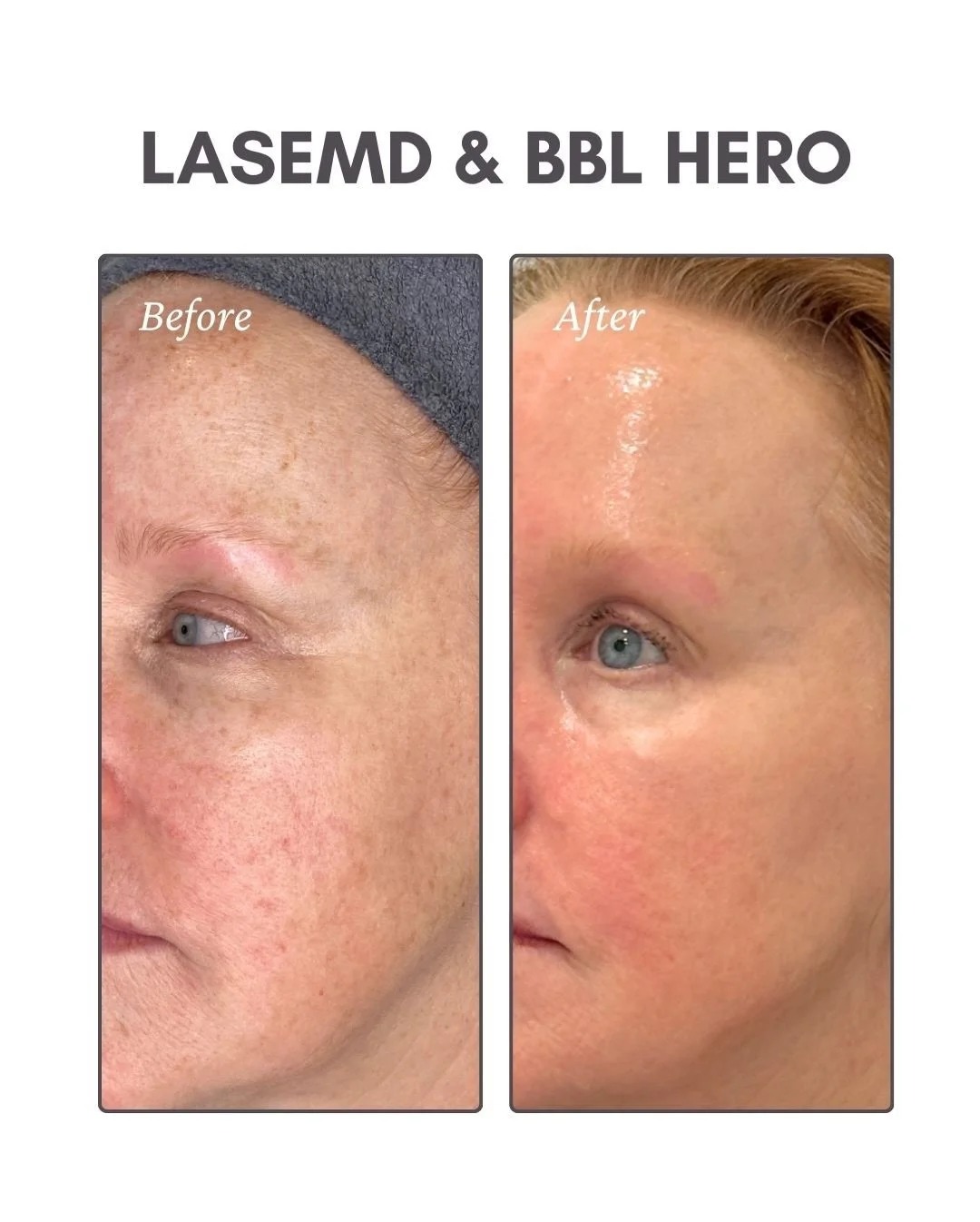 Two years. Same face. Different story ✨

This glow wasn&rsquo;t a quick fix, it was a slow burn. Like layering skincare the right way, consistency did the heavy lifting.

📸 Before &rarr; After
Built with LaseMD + BBL HERO, regular visits on the Flex