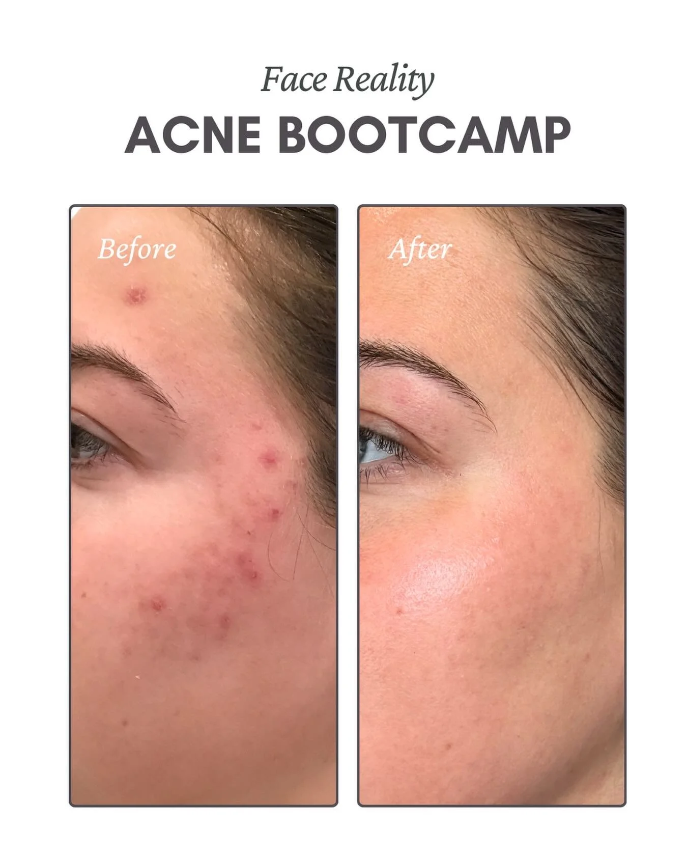 Wedding-Ready Glow!💍⭐️

After several months of dedication, this beautiful transformation shows the power of consistency. She completed our Face Reality Acne Bootcamp - Every 2-week facial + regular use of Face Reality products🤍

Consistency + the 