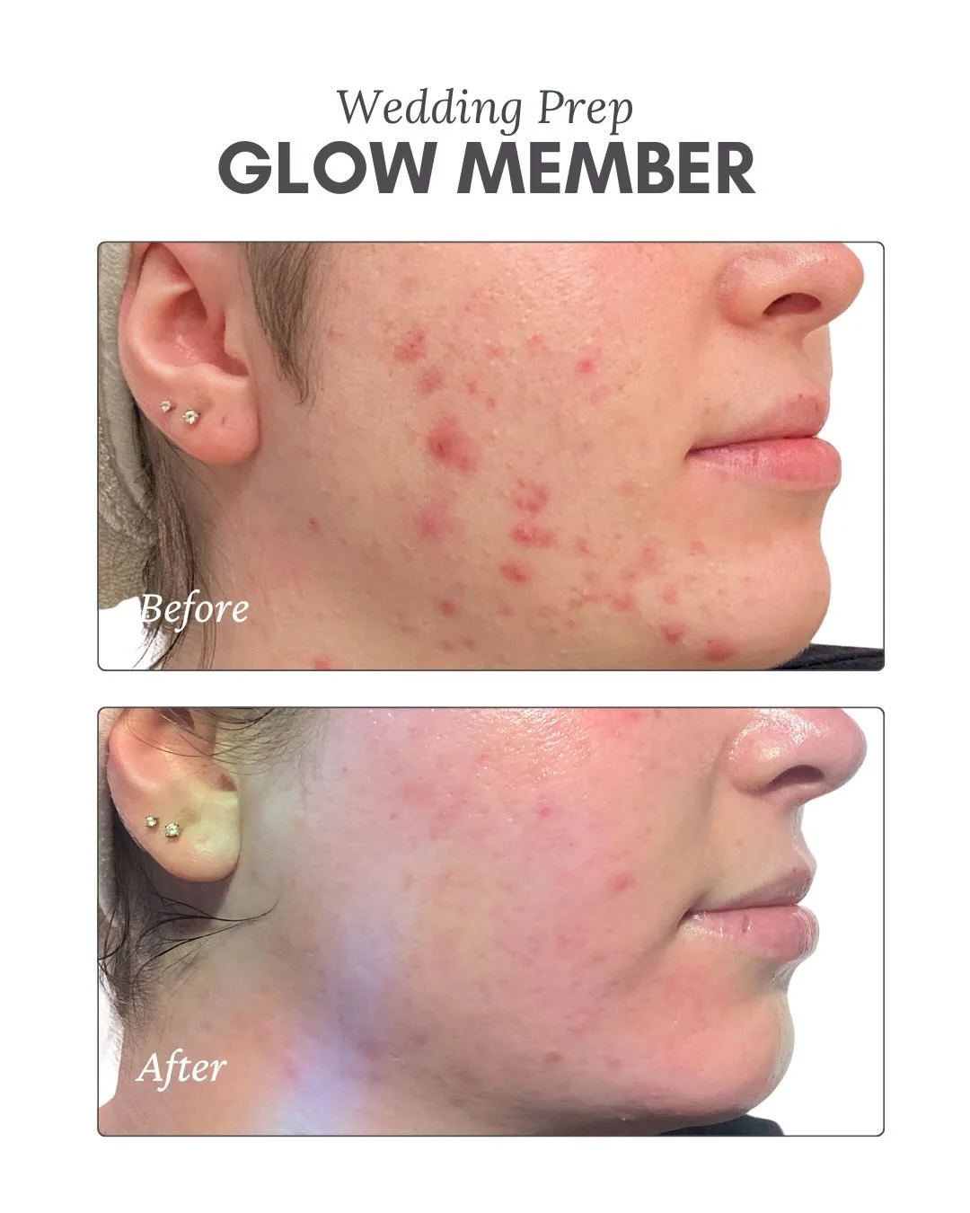 💍BRIDAL SKIN TRANSFORMATION💍
 
Our bride-to-be started her Jolie Glow Member journey in December 2025 with one goal in mind: to build healthy, radiant skin for her October 2026 wedding💍💒🤍

Instead of looking for a quick fix, she committed to con