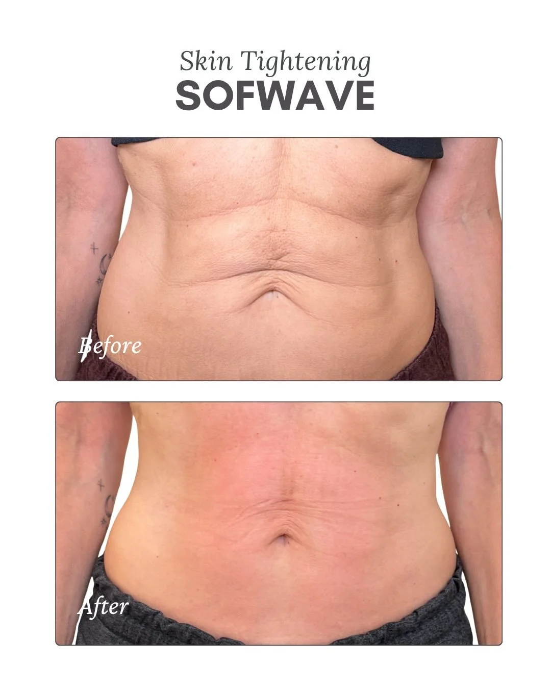 One Sofwave treatment. These results 🤯💣✨

This before &amp; after was taken one month after a single Sofwave treatment on the abdomen, showing a noticeable improvement in skin tightening &amp; firmness!

✨How she got to these results✨
&bull; 1 Sofw