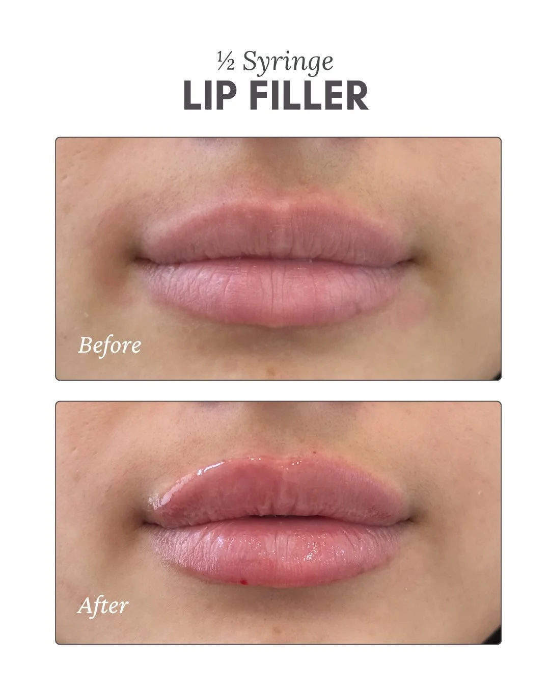 Plot twist: &ldquo;Just a little&rdquo; was actually the perfect amount💋

#lipfillerbeforeandafter #lipfiller #hudsonvalley #medispa #summeressentials