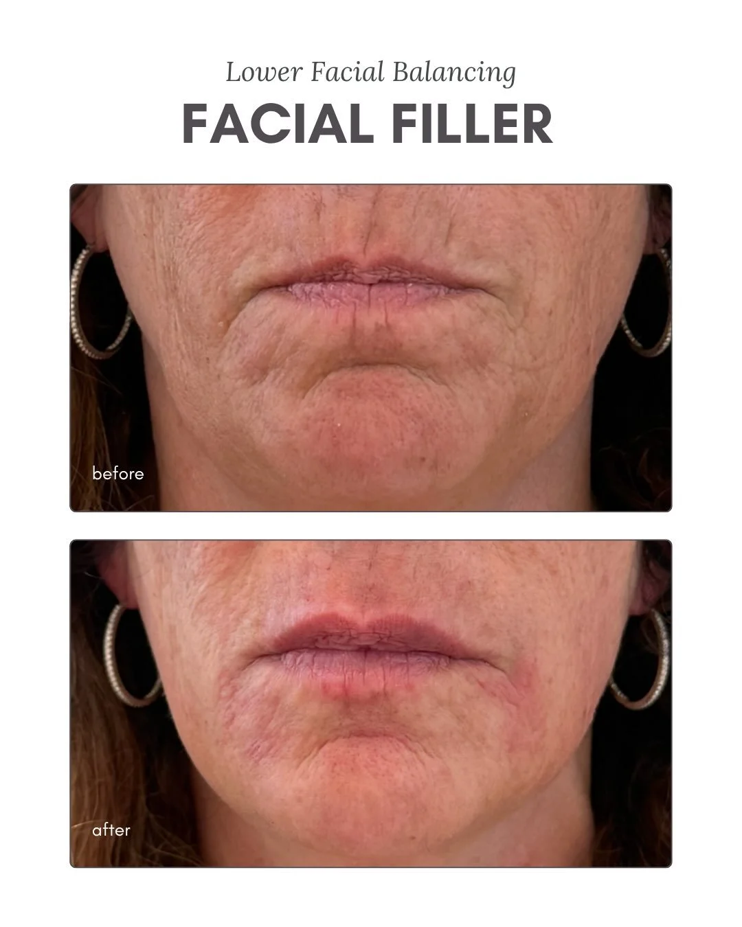 One syringe can make a difference. But multiple syringes? That&rsquo;s where the transformation happens!✨

Lower facial balancing isn&rsquo;t about adding more, It&rsquo;s about building harmony!

Sometimes that means treating the chin, jawline and s