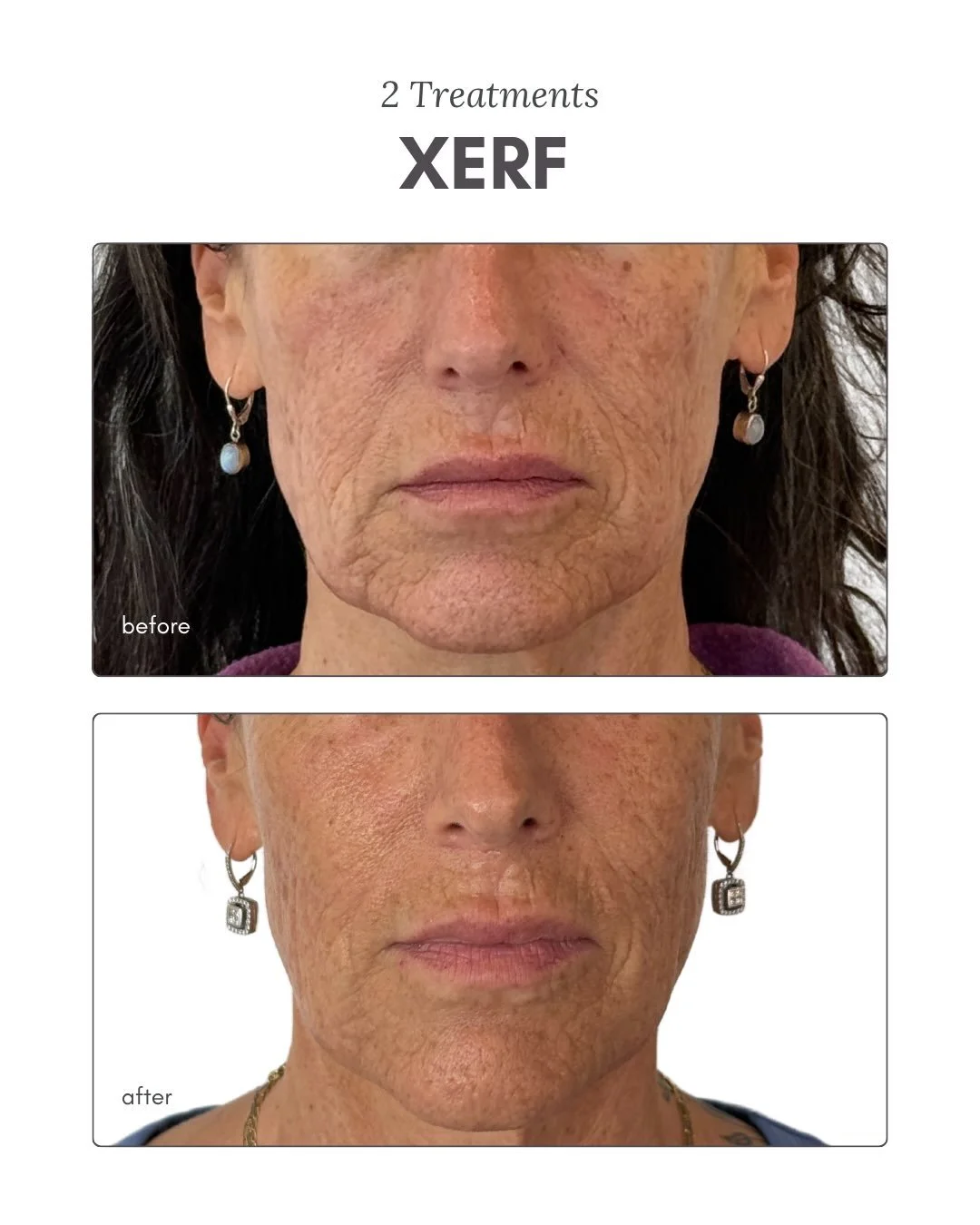 Two treatments later &amp; suddenly XERF is making a point👀🔥

In just 2 months, we are already seeing softer lines, a more lifted appearance through the jawline, and subtle tightening💪

A littler tighter. A little more defined.

And the best part?