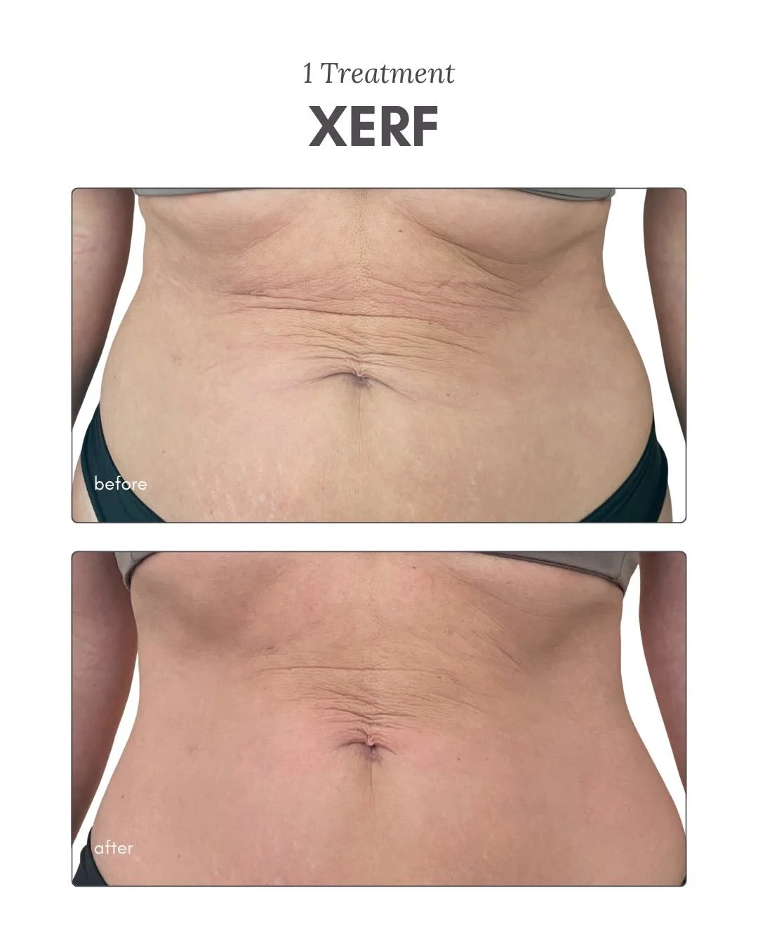 We love Instant gratification 👏🏻🔥

This Xerf before &amp; after was taken the same day&hellip;. And the best part? The results only get better as the days go on. Xerf continues collagen long after the appointment is over💪

Basically, the collagen
