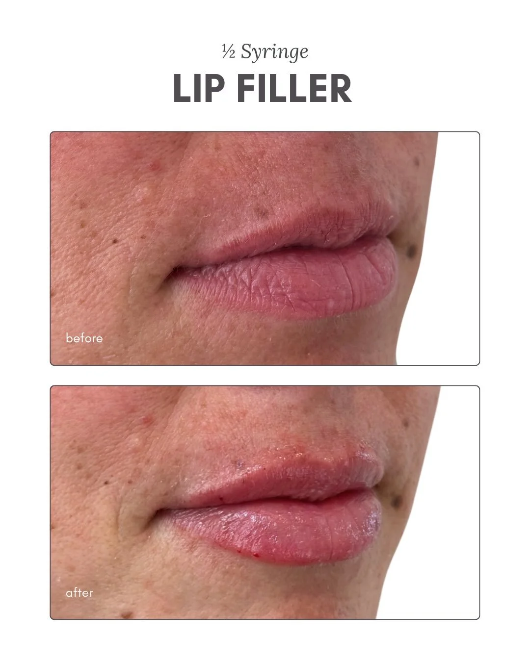 For the girls who just want a little extra something💋💉

A touch of volume + definition can go a very long way💘

#lipfiller #hudsonvalley #eastdalevillage #filler #lipfillerbeforeandafter